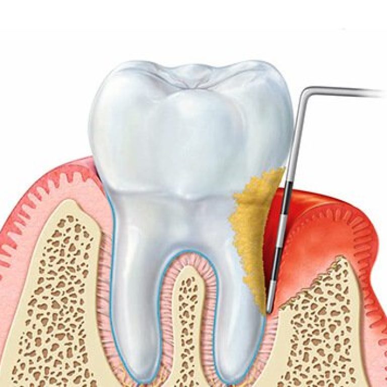 Parodontologia_Prevident_Santena_Torino