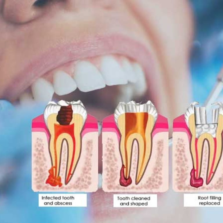 root-canal-treatment