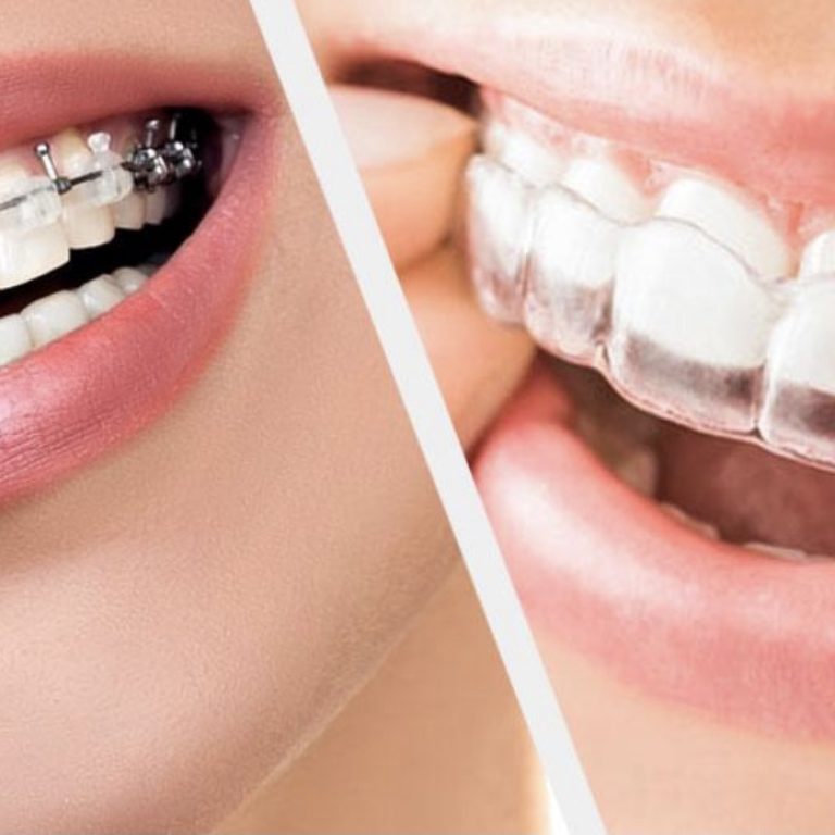 tauntonorthodontics-why-orthodontic-treatment-is-important