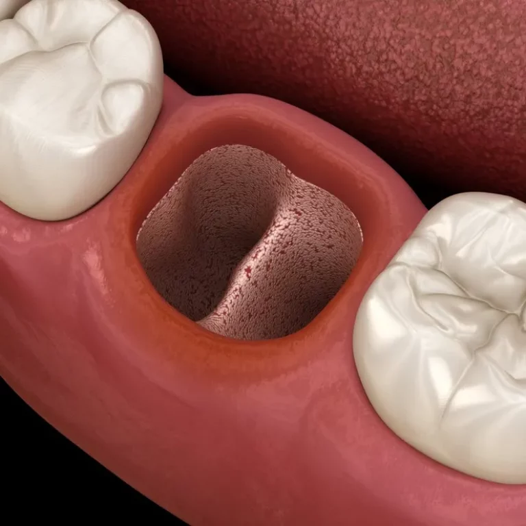 tooth-extraction